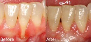 Gum Grafting